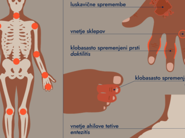 Biološka terapija za sve pacijente SBK kantona